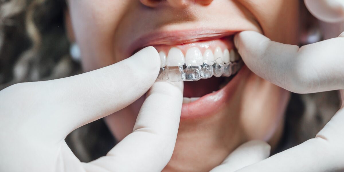 Doctor putting a clear dental aligner to the patient woman TranscenDental Smiles is a trusted ORTHODONTIC TREATMENT provider